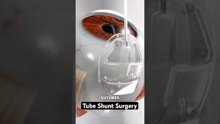 Reducing pressure to prevent vision loss (3D Animation)