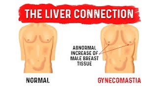 What is Gynecomastia (Man Boobs) - Dr.Berg on Liver