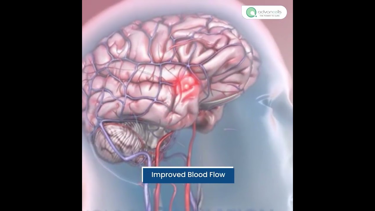Transform Your Life with Stem Cell Therapy for Stroke Recovery