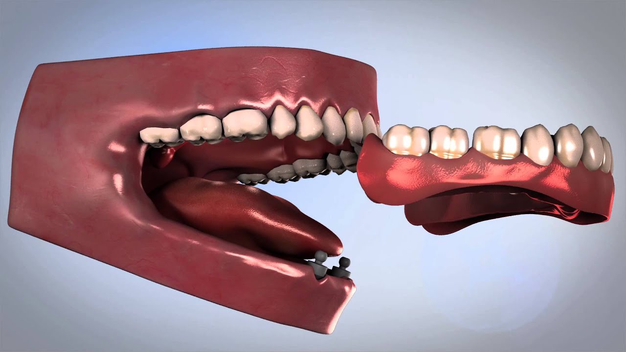 English: Replacing a Missing Teeth - cortex dental implants