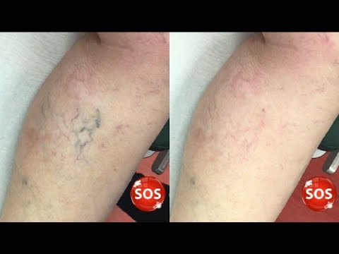 Varicoza chirurgie laser