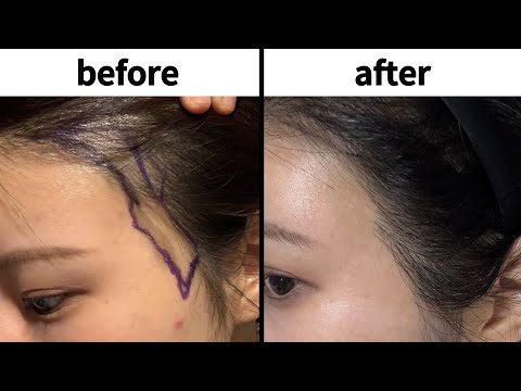 Her Whole Face Changed! 8 Months Post FUE | Real Story