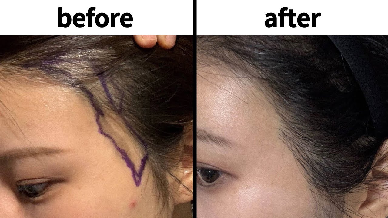 Her Whole Face Changed! 8 Months Post FUE | Real Story