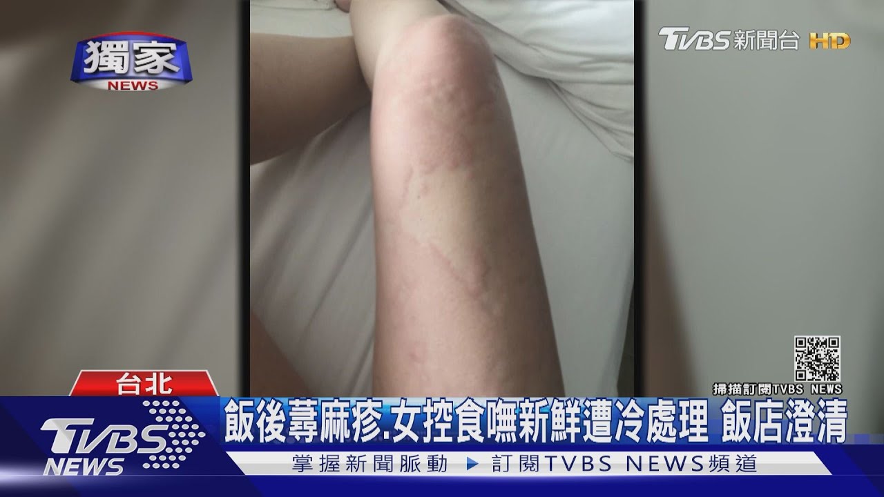 飯後蕁麻疹、女控食嘸新鮮遭冷處理 飯店澄清