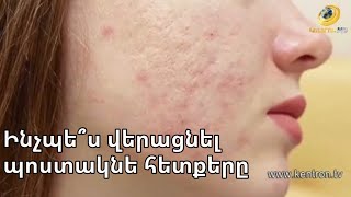 Ինչպե՞ս վերացնել ակնեն