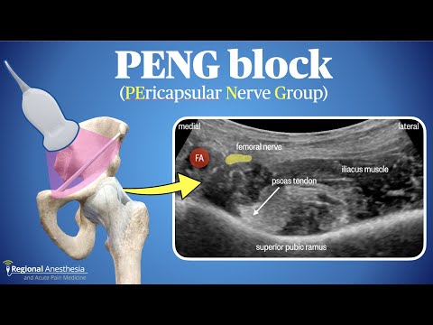 PENG Block (Pericapsular Nerve Group Block)