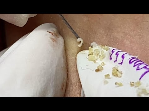 Loan Nguyen Acne Treatment (#108)