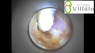 耳掃除動画vol.38「奥までガッチリ飴色耳垢」