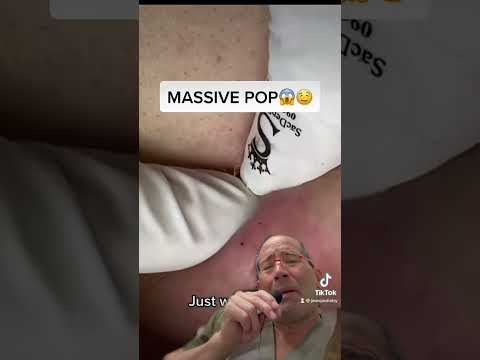 EXPLOSIVE PIMPLE POP💥#shorts