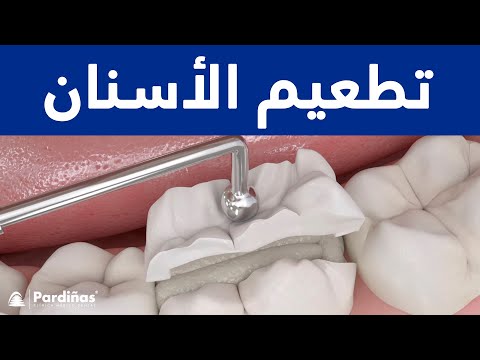 © تطعيم الأسنان