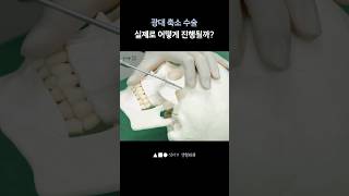 광대뼈 축소술 성형 시술