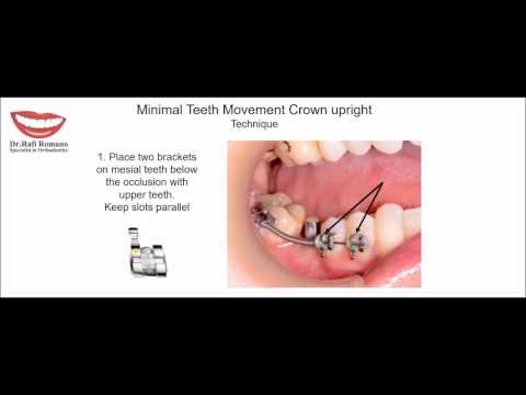 Minimal Teeth Movement - Crown upright. Rafi Romano