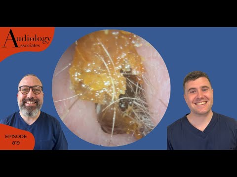 EAR WAX REMOVAL COMPILATION INC LONG KERATIN STRIPS & WAX PLUGS -EP819