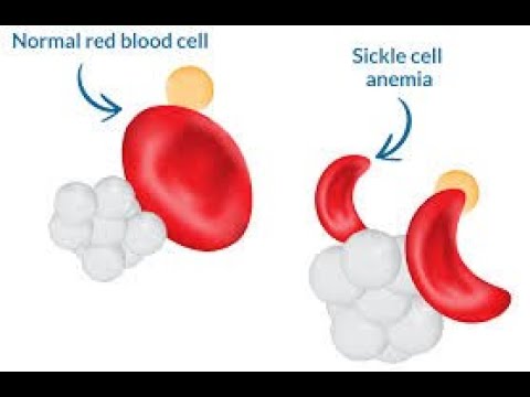 Vaso-okklusive Krise, hyperhämolytische Krise, Sequestrationskrise und aplastische Krise