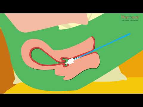 Pinworm megelőzés és kezelés