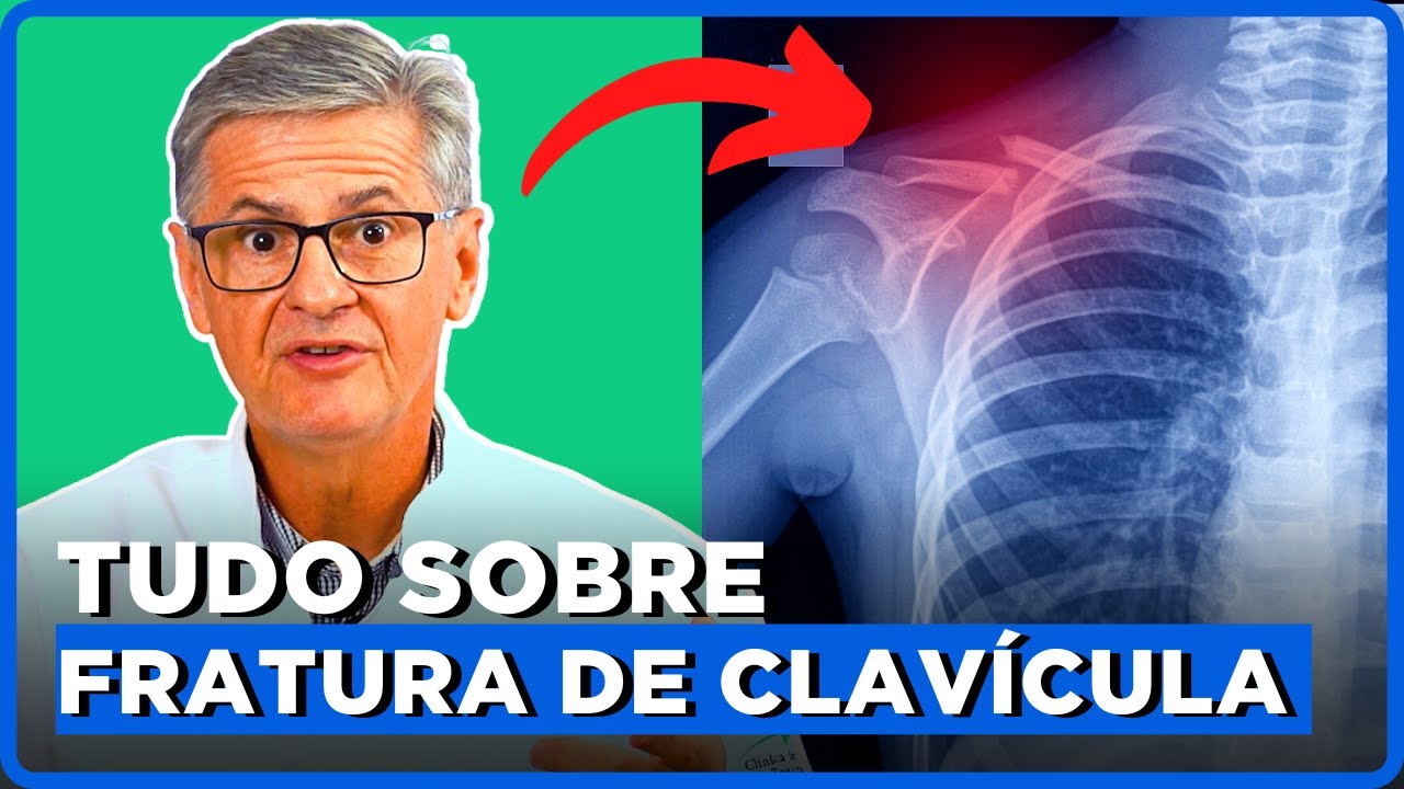FRATURA DE CLAVÍCULA: Como acontece, Sintomas e Tratamentos | Simplificando Ortopedia