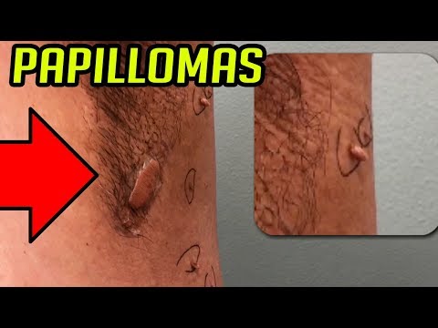 Hpv vírus tumor