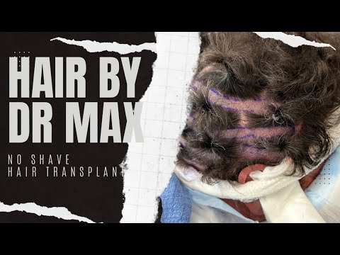 Celebrity Hair Transplant at Hair By Dr. Max - the ultimate no-shave hair restoration solution!