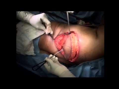 Surgery for Breast Cancer - Skin Sparing Mastectomy and LD Flap