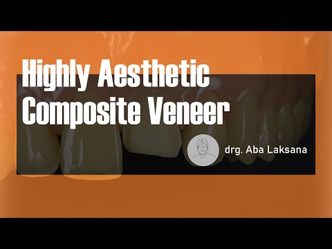 Direct Composite Veneer with 2 Layers Technique 