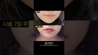 장원영 되기 1일차💗 ft. 입술필러