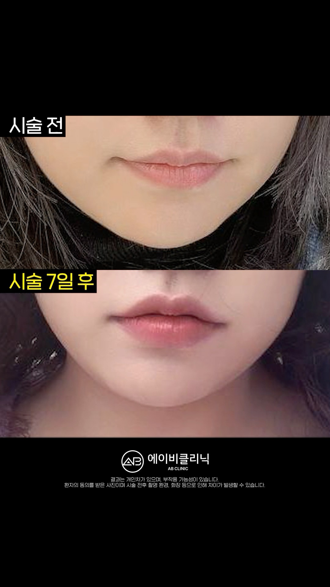 장원영 되기 1일차💗 ft. 입술필러