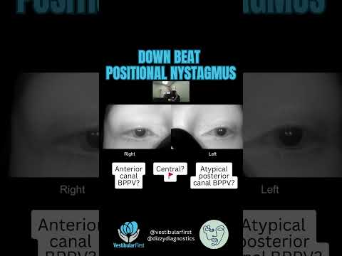 Downbeat nystagmus in Dix-Hallpike test - central or peripheral? #bppv #vestibularrehabilitation