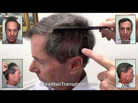 Dr. Brett Bolton MaxHarvest&trade; Plus corrective surgery Patient Dillon

