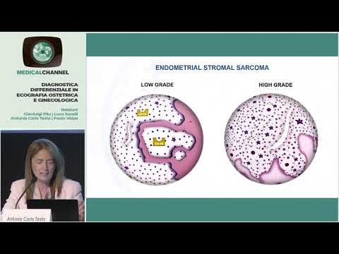 Epidemiologia dei sarcomi - A. C. Testa