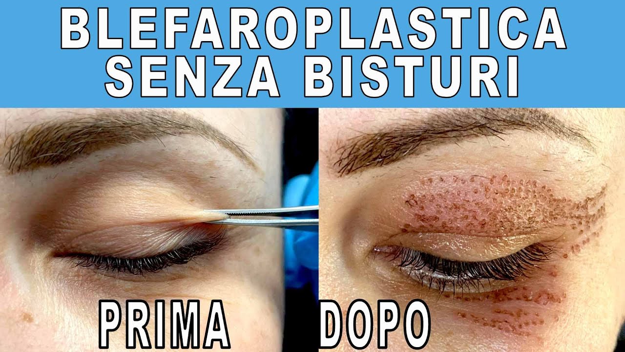 BLEFAROPLASTICA SENZA BISTURI - PRIMA E DOPO - Heller Gratitude