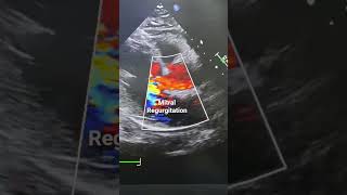 Download lagu Mitral Regurgitation lesion #MR #2decho #VHD mp3 Download lagu Mitral Regurgitation lesion #MR #2decho #VHD mp3