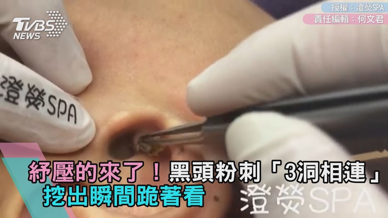 紓壓的來了!黑頭粉刺「3洞相連」 挖出瞬間跪著看