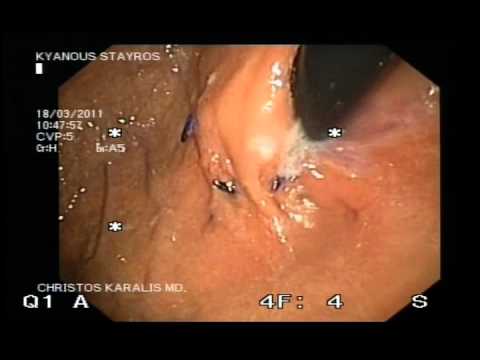 Result Of Esophyx Procedure - Lower Esophageal Sphincter Look
