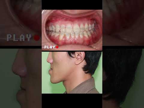 Occlusion Class III braces