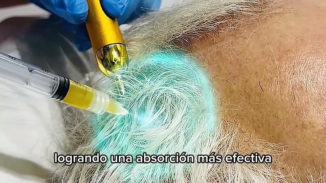 Implante capilar