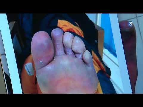 Emmanuel Cauchy, urgentiste spécialisé à Chamonix prend en charge les blessures d'Elisabeth Revol