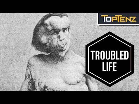 10 Sad Facts About “The Elephant Man” Joseph Merrick