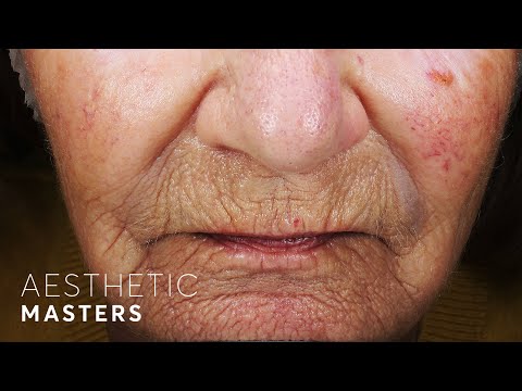 Laser Resurfacing for Deep Wrinkles - CO2 Laser