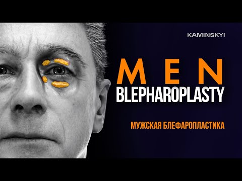 Мужская пластика век. Техника и результаты. Men blepharoplasty. Technique and results / KAMINSKYI