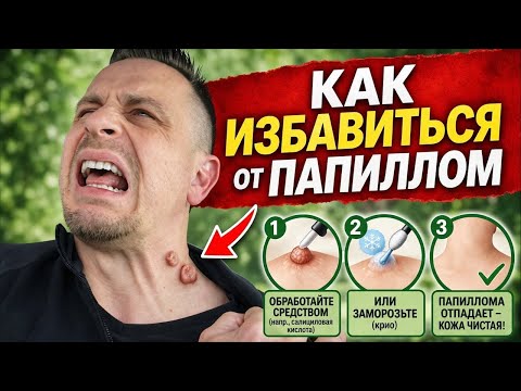 Как избавиться от папиллом (и почему они появляются снова)