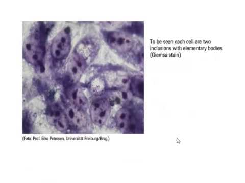 Il lgg lyambliya quello che è questo e come trattare Eccetto intestini il helminths può colpire altri corpi