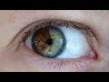 Doctor Turns Brown Eyes Blue Permanently with ...