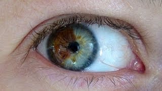 Doctor Turns Brown Eyes Blue Permanently with Laser
