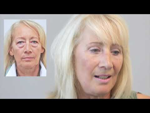 Echte Erfahrungen: "So lief meine Augenlid-OP gegen Schlupflider & Tränensäcke“ bei Dr. Aral LIDMED®