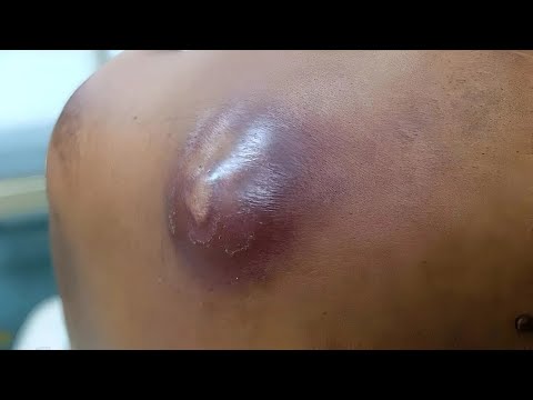 Carbuncle, Boil & Furuncle Abscess Removal