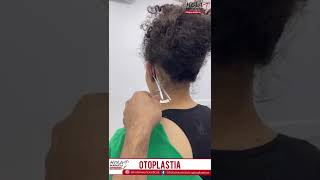 ✨OTOPLASTIA resultados increíbles y de inmediatos solo en #holamauricio