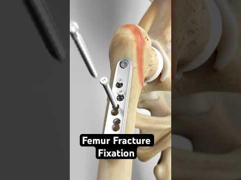 Femur Fracture Fixation (Dynamic Hip Screw Method)