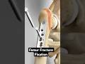 Femur Fracture Fixation (Dynamic Hip Screw Method)