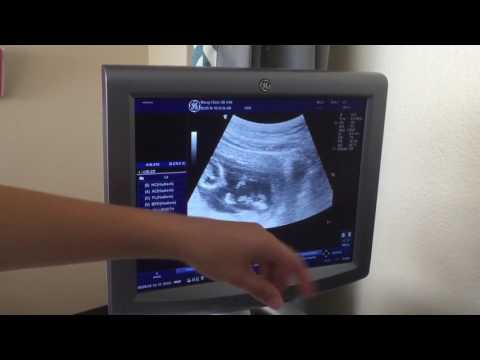 Ultrasound 13 weeks 0 day