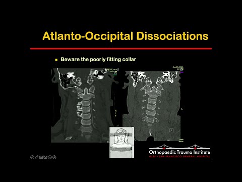 Evaluation and Treatment of the Pediatric Spine Trauma Patient - Ashraf El Naga, MD